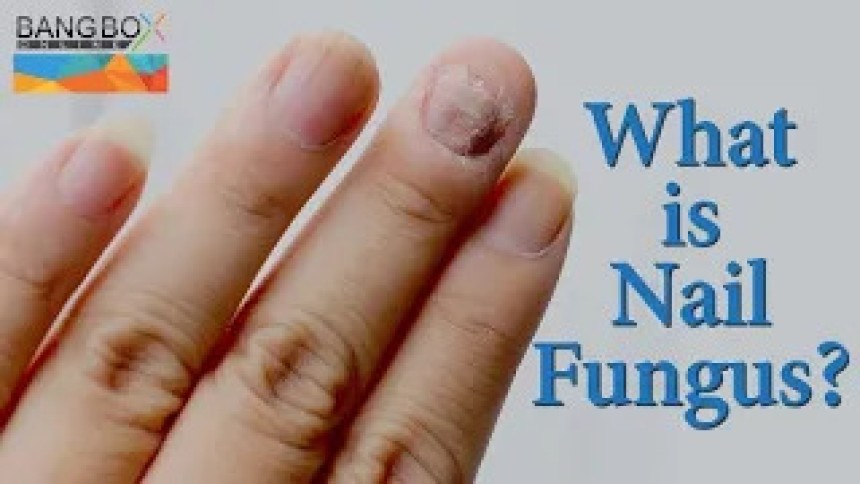 Nail Fungus it's Symptoms, Causes, and treatment II Bang Box Online Official