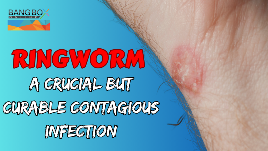Ringworm: A crucial but treatable contagious infection