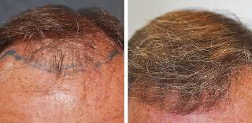 How Hair Density Affects Transplant Results