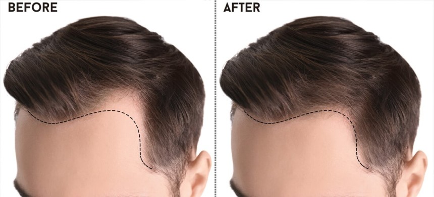 Reviving Confidence: The Journey of Hair Transplant in Pakistan