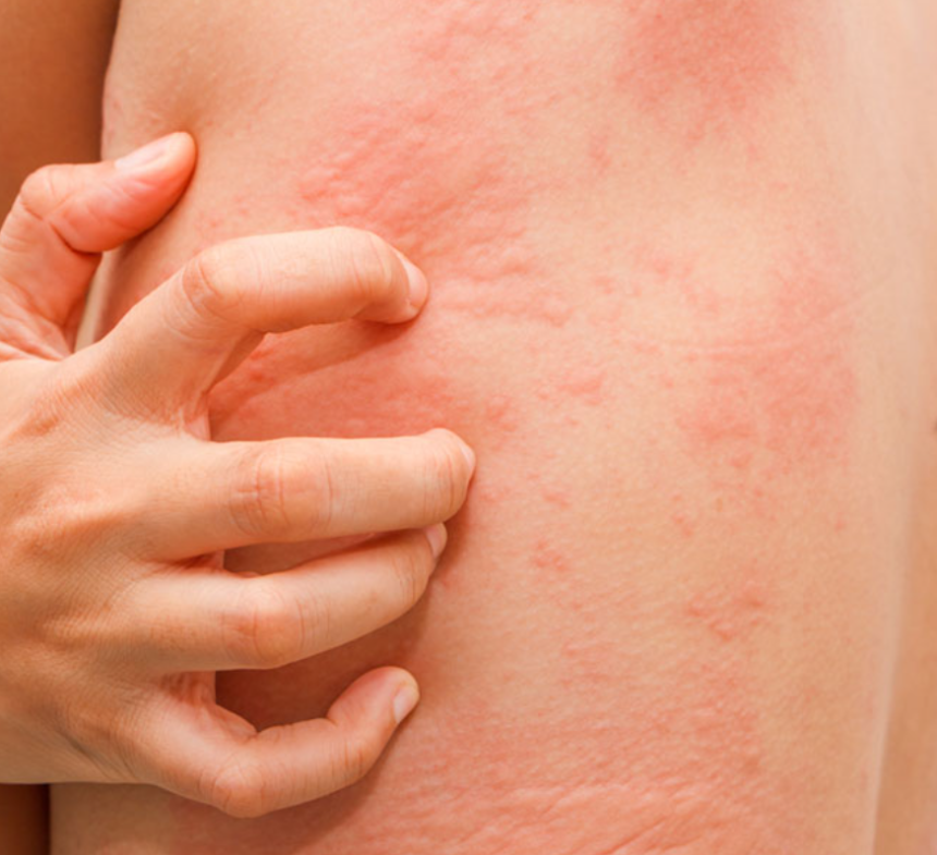 Ayurvedic treatment for hives