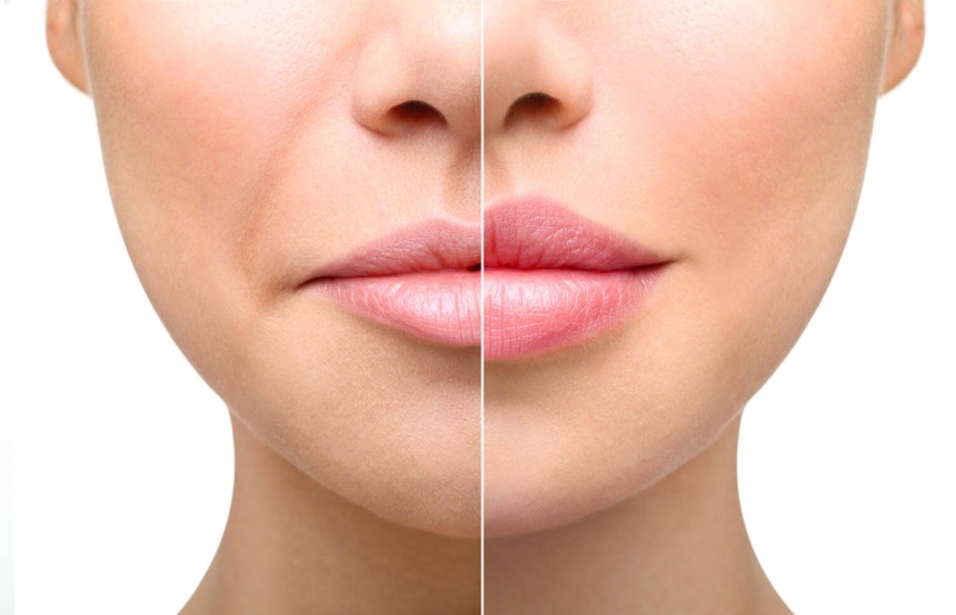 Everything You Need to Know About Lip Augmentation in Islamabad