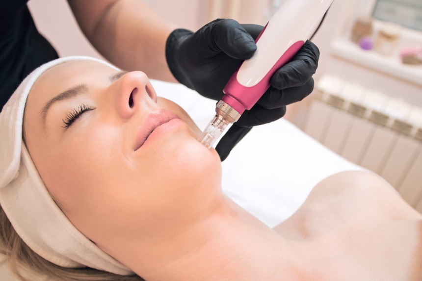 The Ultimate Guide to Microneedling in Islamabad: Benefits and Procedure