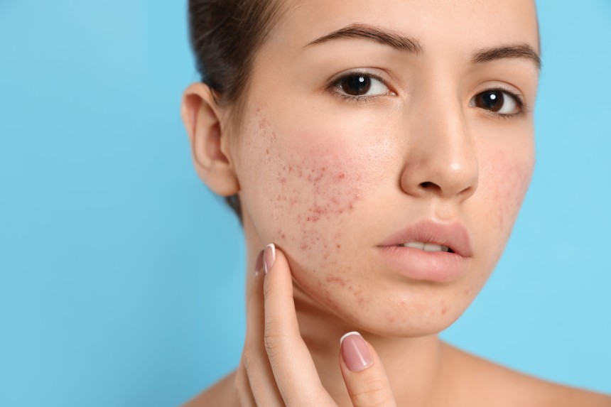 acne scar treatment in Islamabad