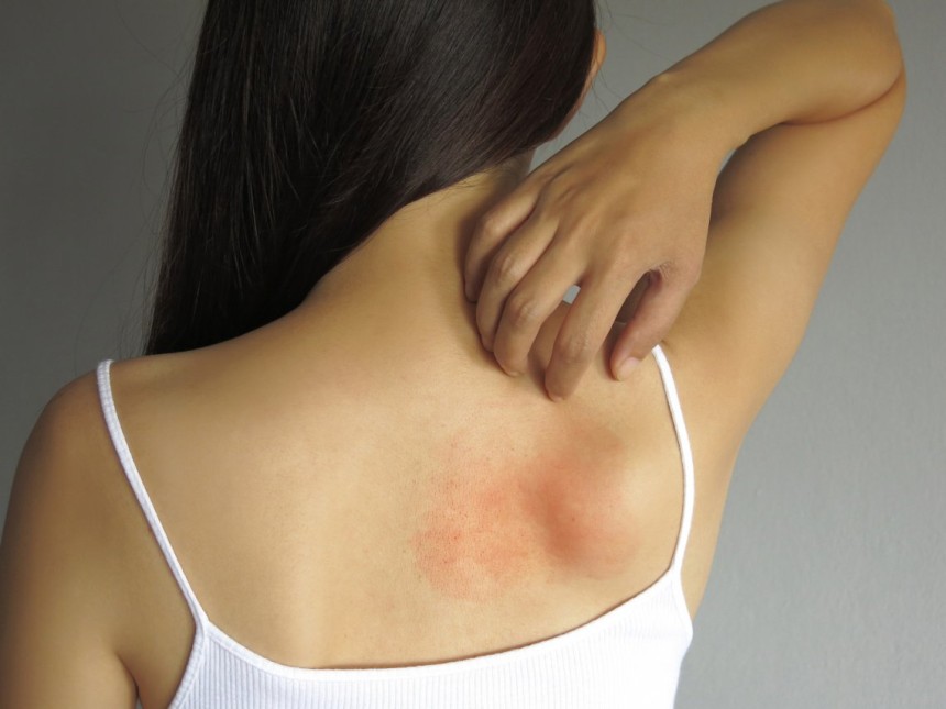 hives treatment in Islamabad