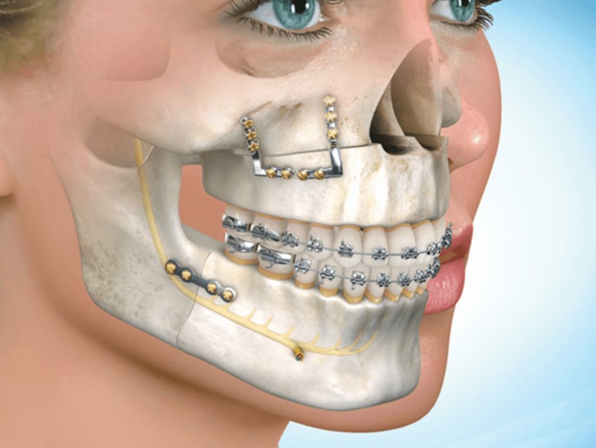 Jaw surgery in Islamabad