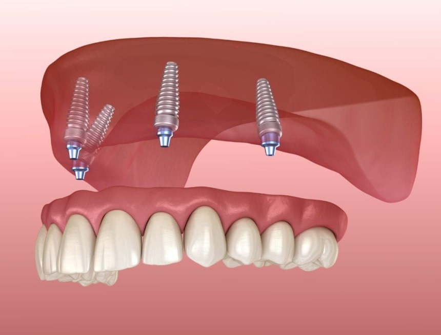 Step-by-Step Process of Getting Implant Dentures