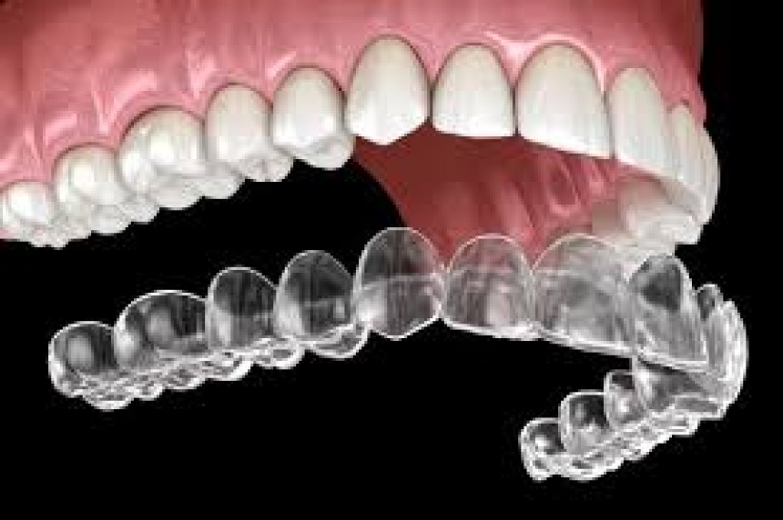 The Long-Term Benefits of Invisalign Treatment for Your Teeth