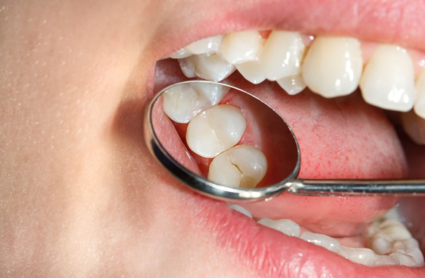 Understanding Tooth Cavities: Early Signs and Treatment Options