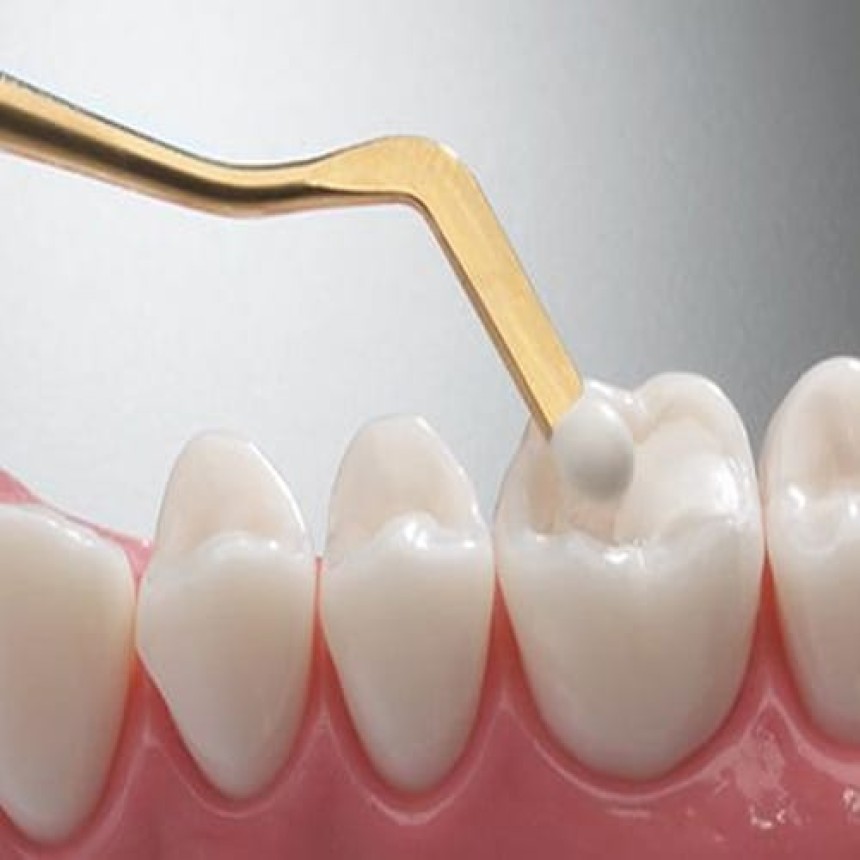 Tooth-Colored Fillings