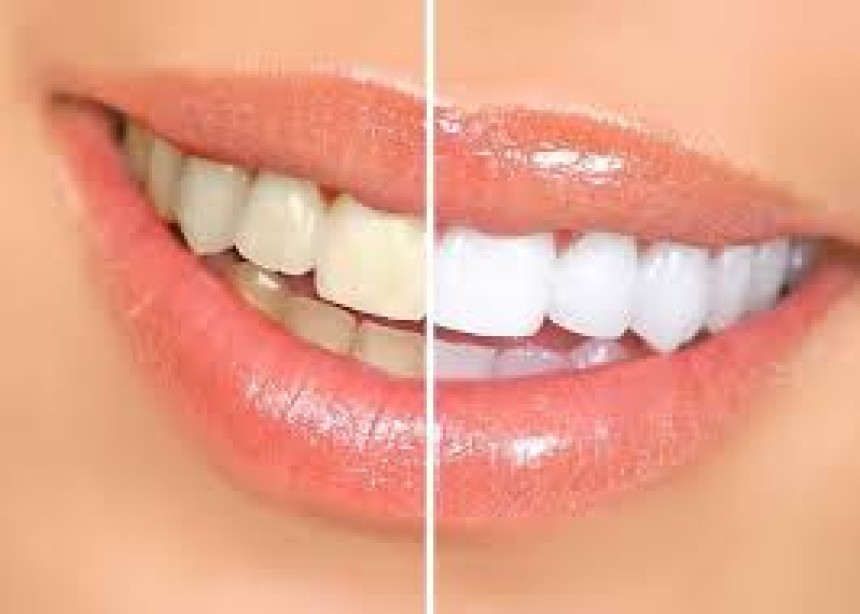 Professional Teeth Whitening vs. At-Home Kits: Which Works Best?