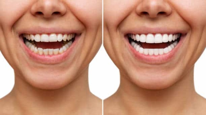 Porcelain vs. Composite Veneers