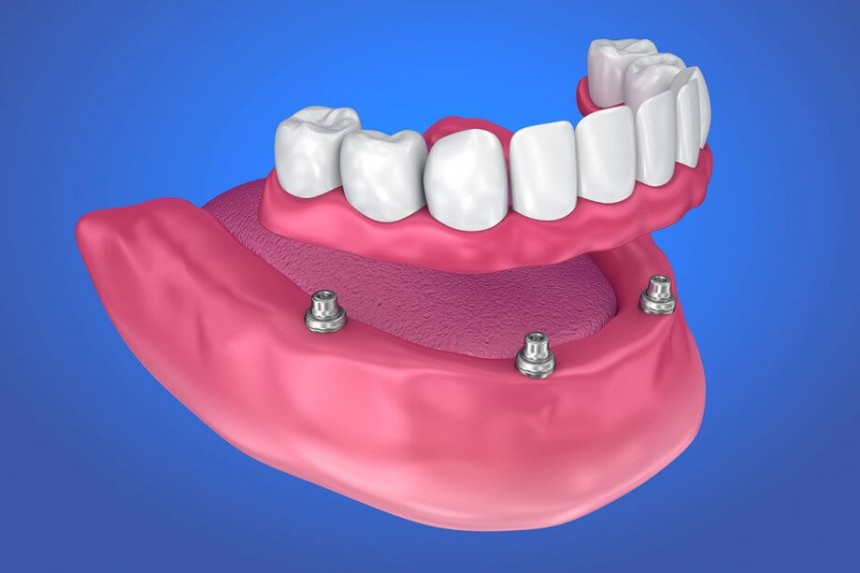 Implant-Supported Dentures