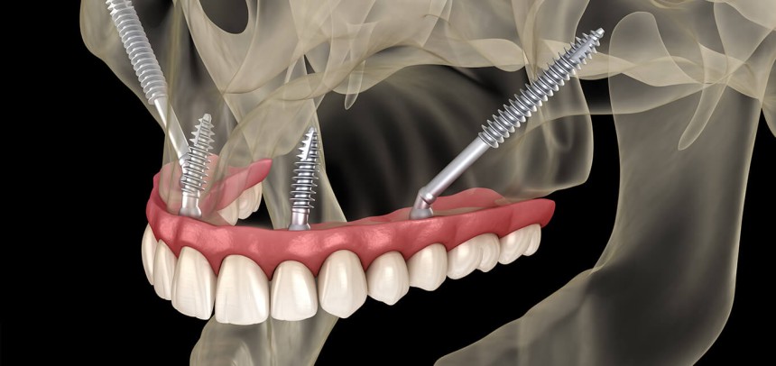 How Zygomatic Implants Provide a Solution for Severe Jawbone Loss