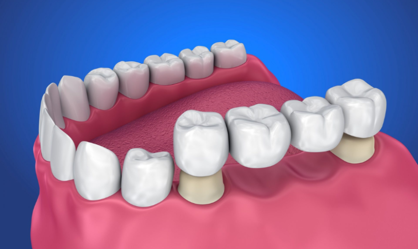 Dental Bridges