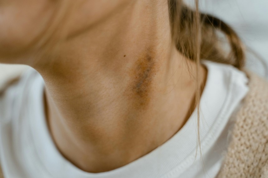 Stages of Wound Healing Pictures