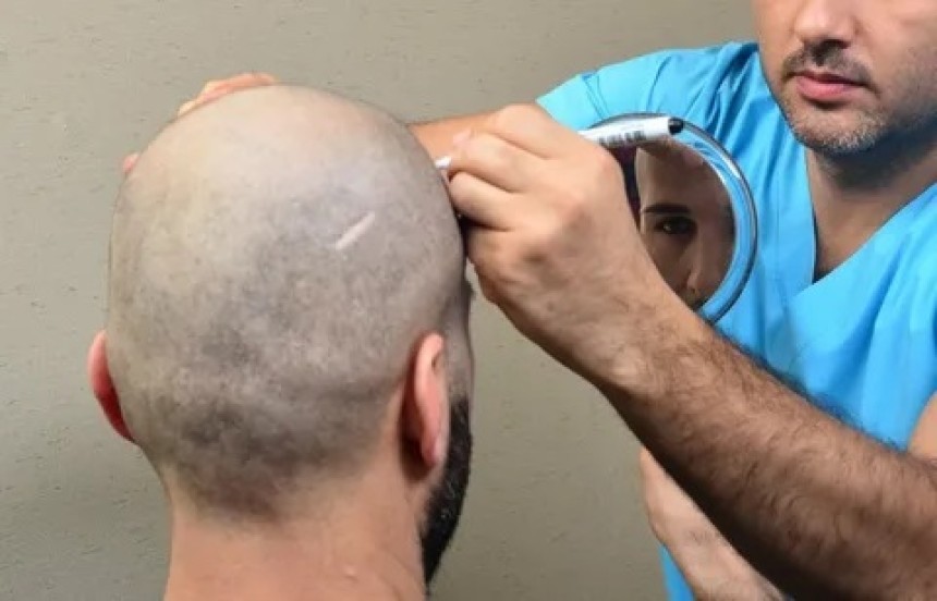 زراعة الشعر