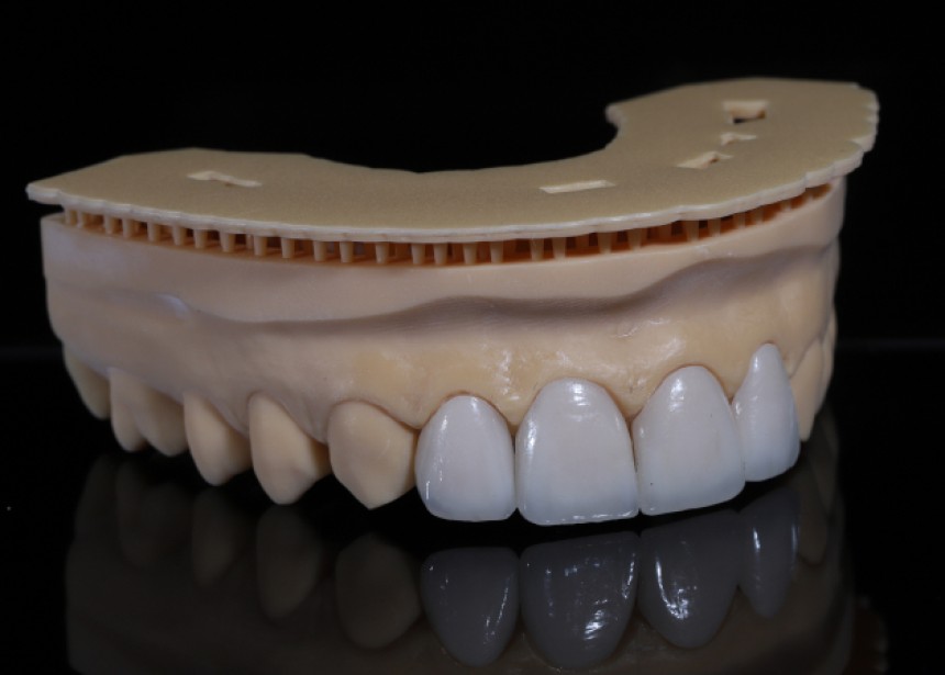 dental veneers