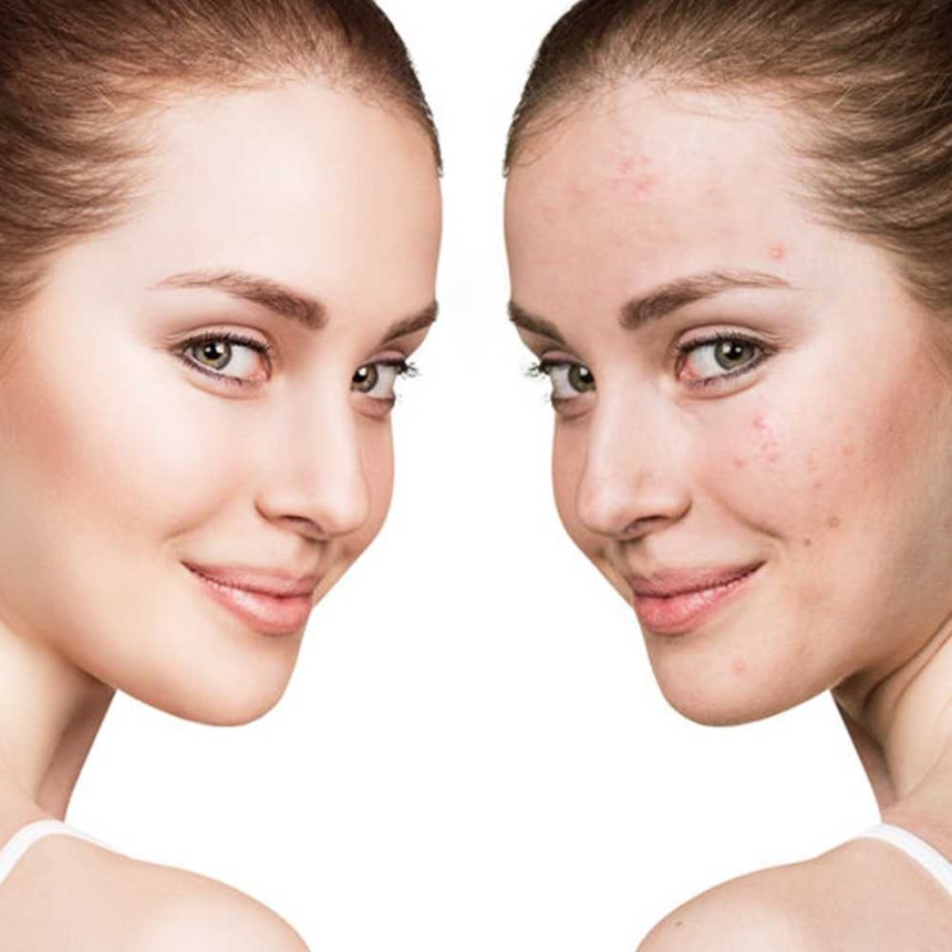 acne scar treatment in Islamabad