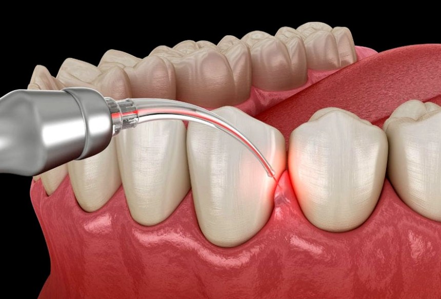 Gum Therapy