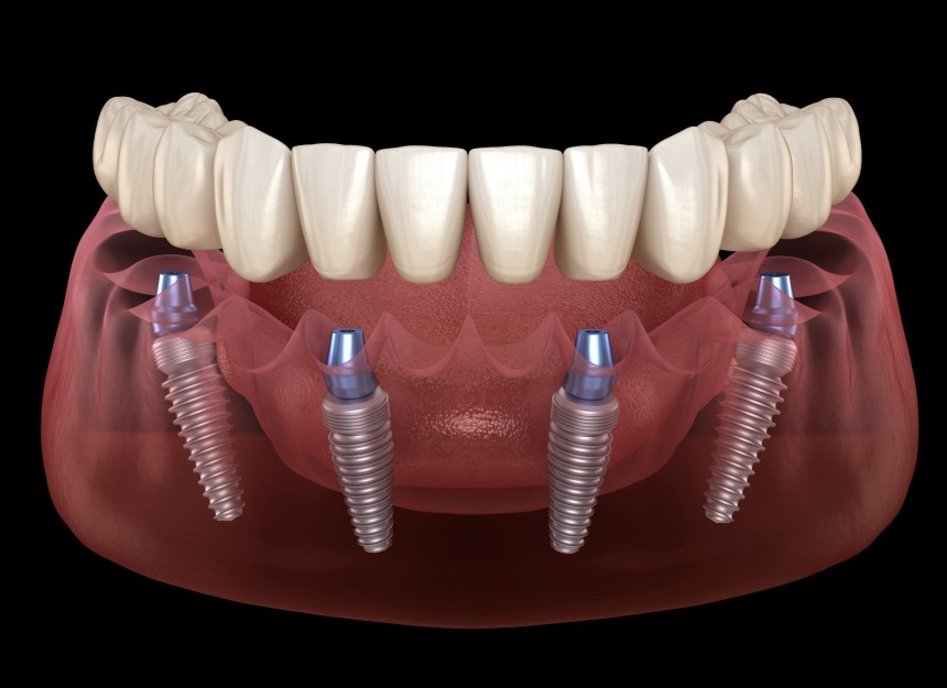 Implants