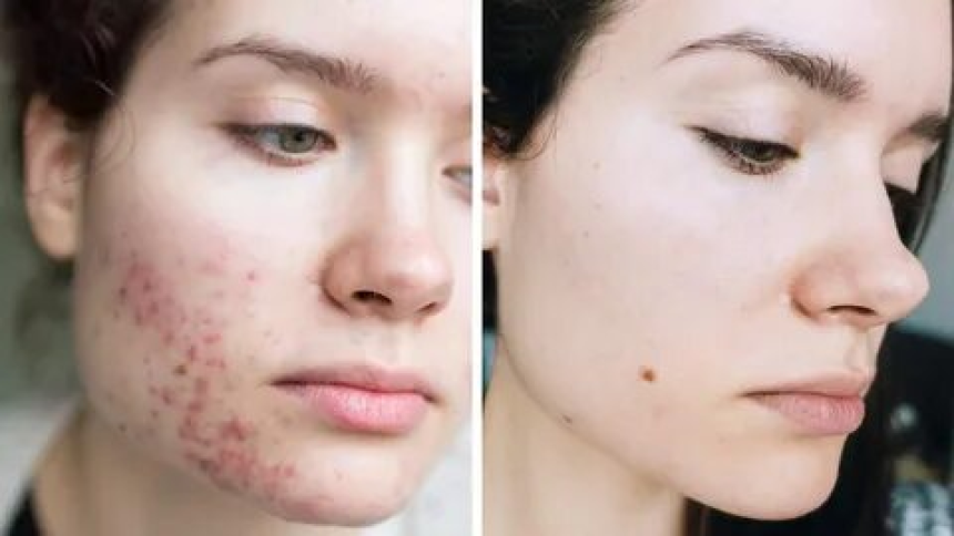 “acne and eczema skin treatment”