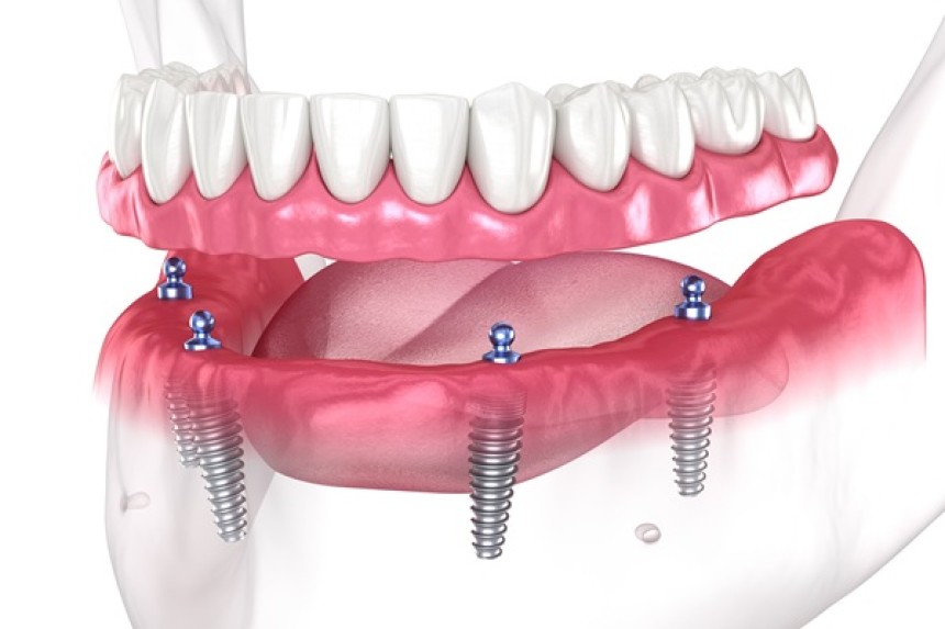 Implant Dentures