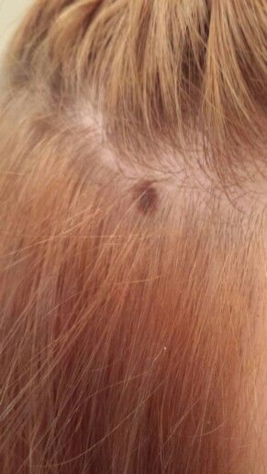 Skin Tag Removal in Riyadh