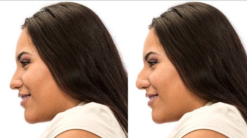 Rhinoplasty in Riyadh