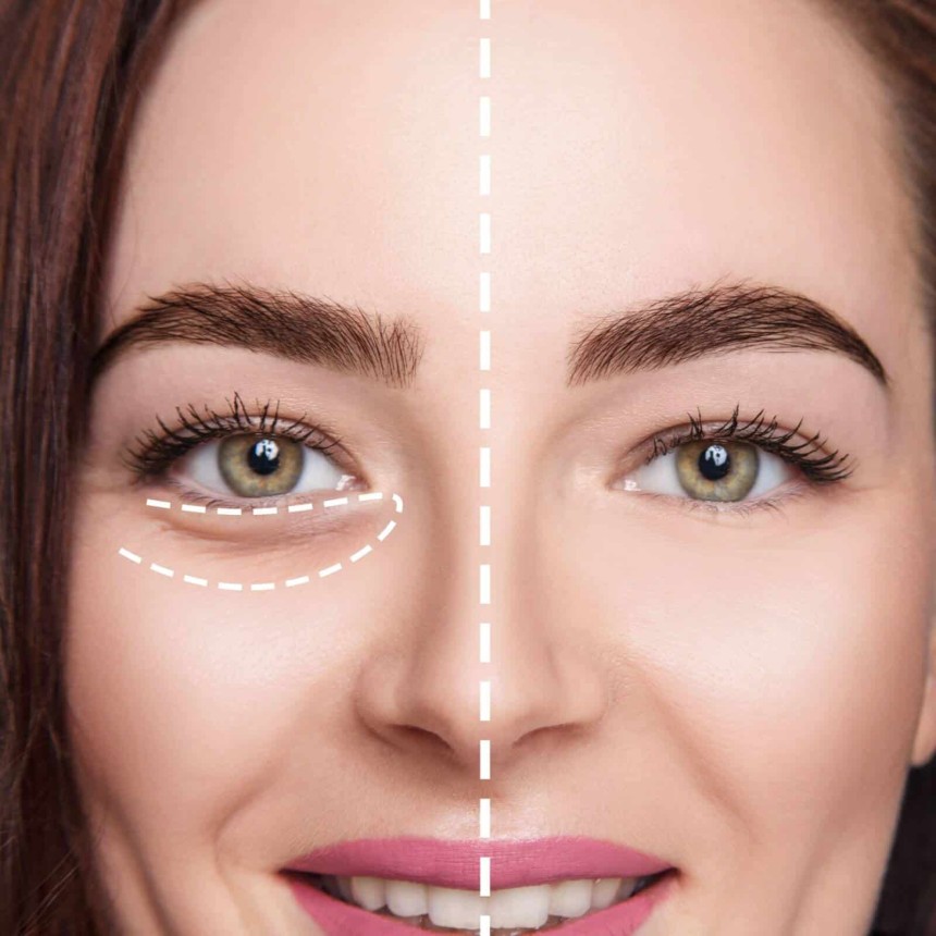 Dark Circles Treatment in Riaydh