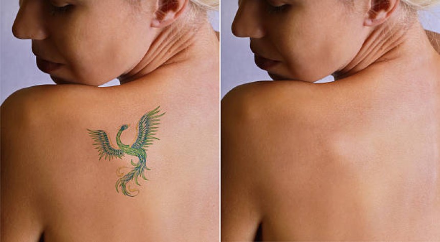 Laser Tattoo Removal in Riyadh