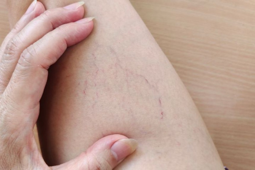 Varicose Veins Treatment