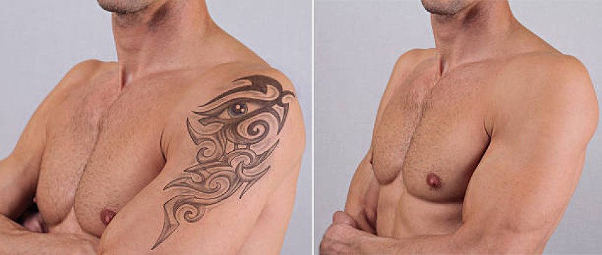 Laser Tattoo Removal in Riyadh