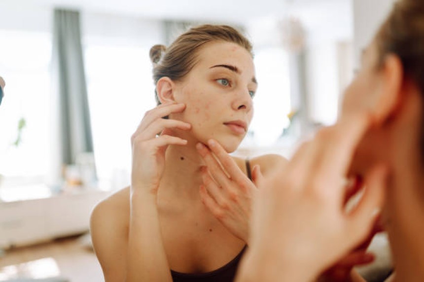 Pimples Treatment in Riyadh