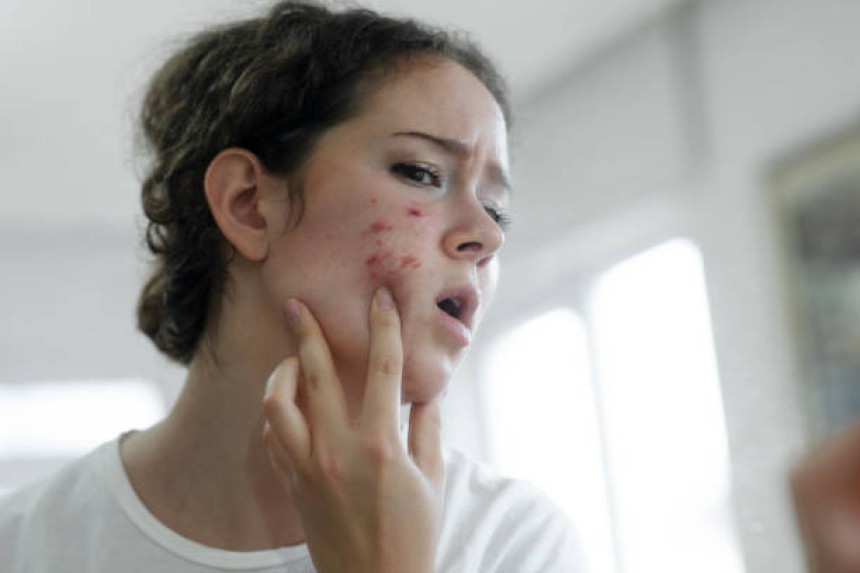 Pimples Treatment in Riyadh