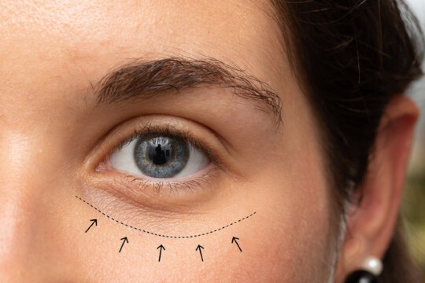 Dark circles Treatment in Riaydh