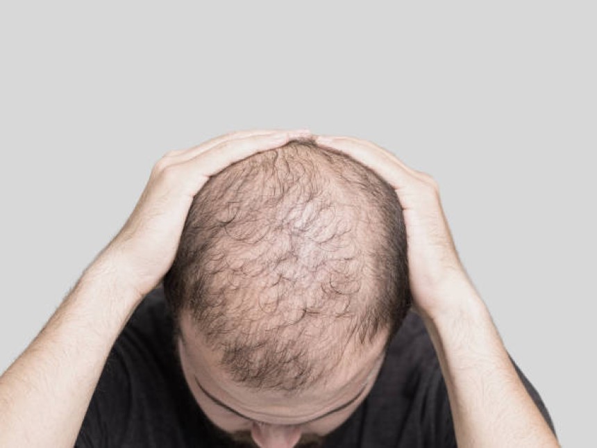 Exosomes Hair Therapy in Dubai