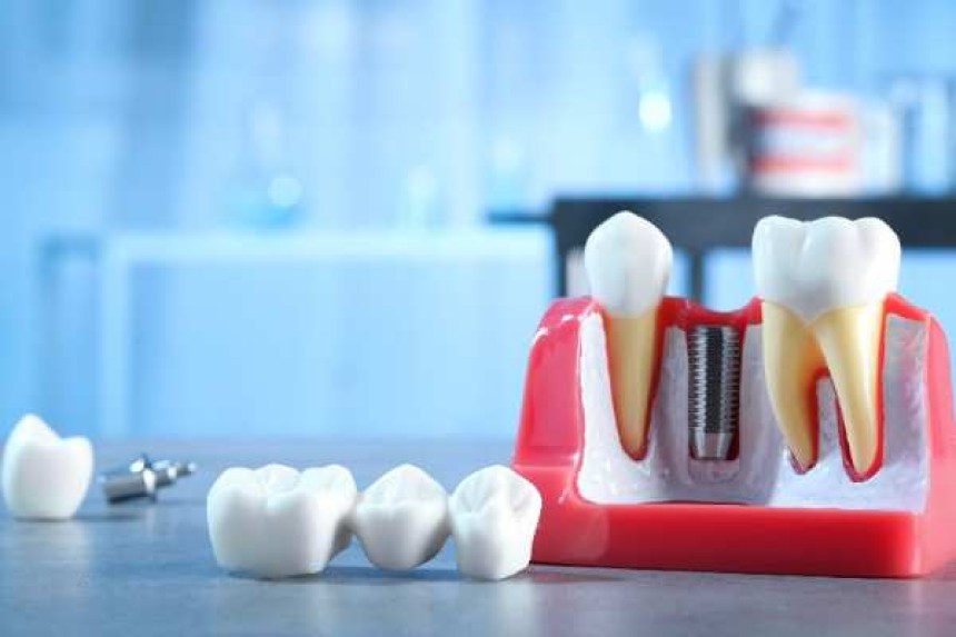 dental implants Salford