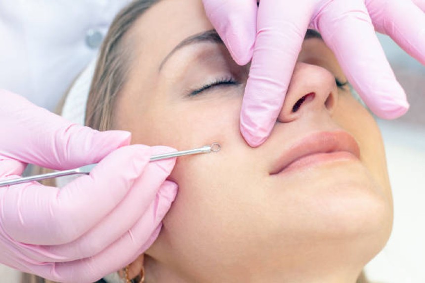 Pimples Treatment in Dubai