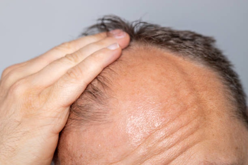 Exosomes Hair Therapy in Dubai