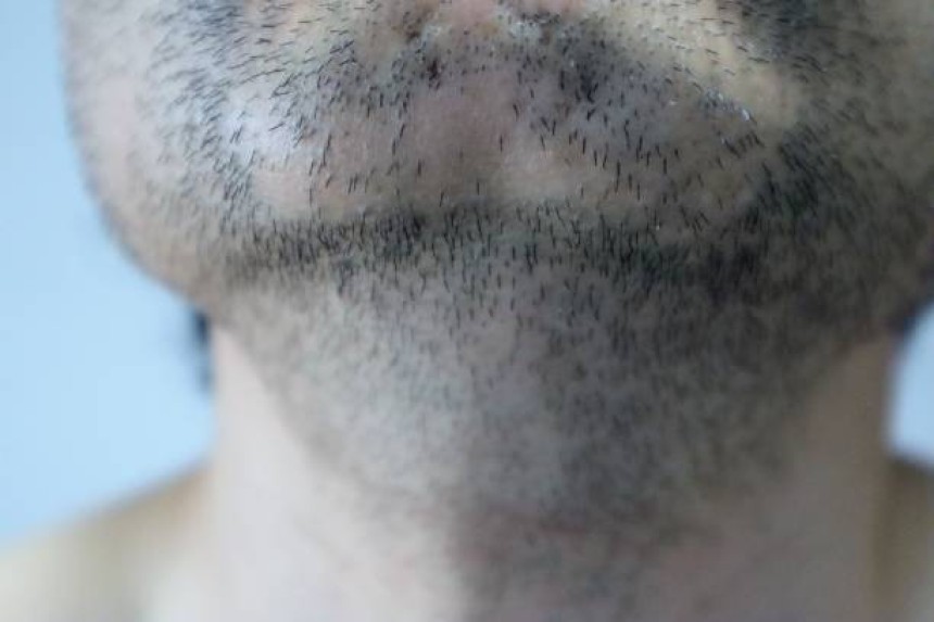 زراعة شعر اللحية في دبي