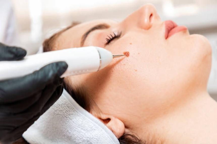 Mole Removal in Dubai