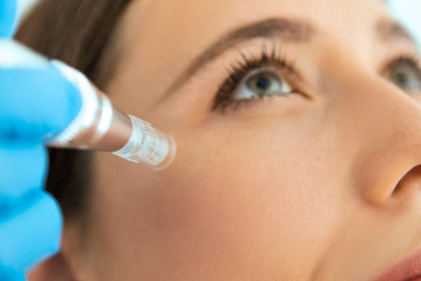 Mesotherapy in Dubai