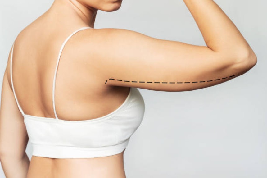 Liposuction in Riyadh