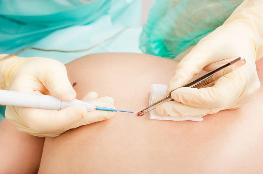 Mole Removal in Dubai