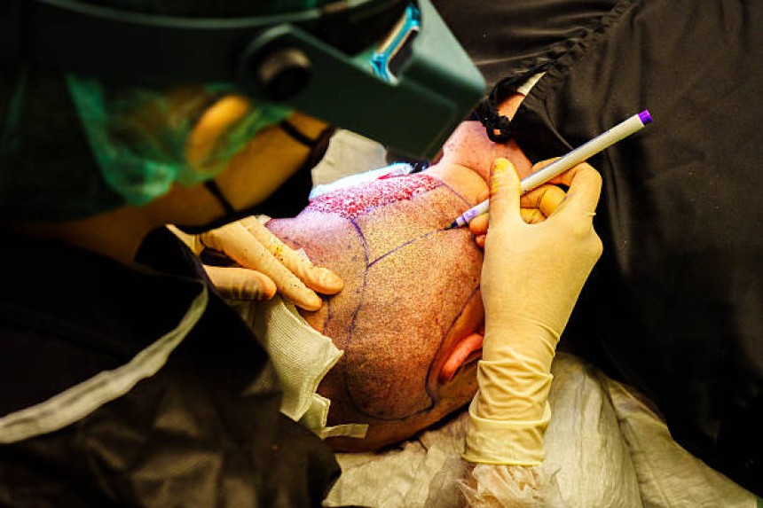 تكلفة زراعة الشعر في دبي