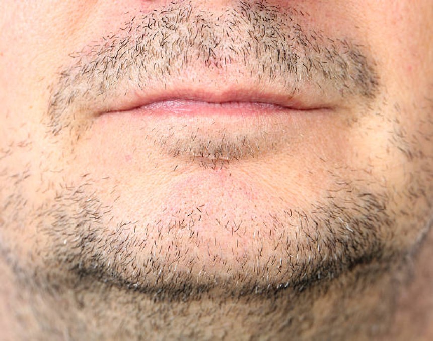 زراعة شعر اللحية في دبي