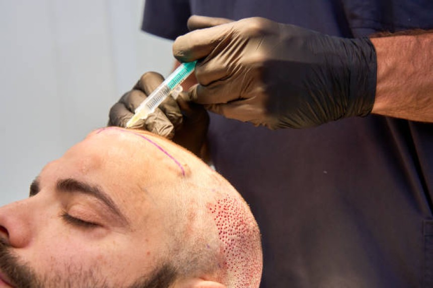 تكلفة زراعة الشعر
