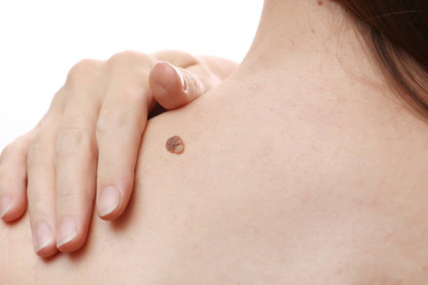 Mole removal in Dubai
