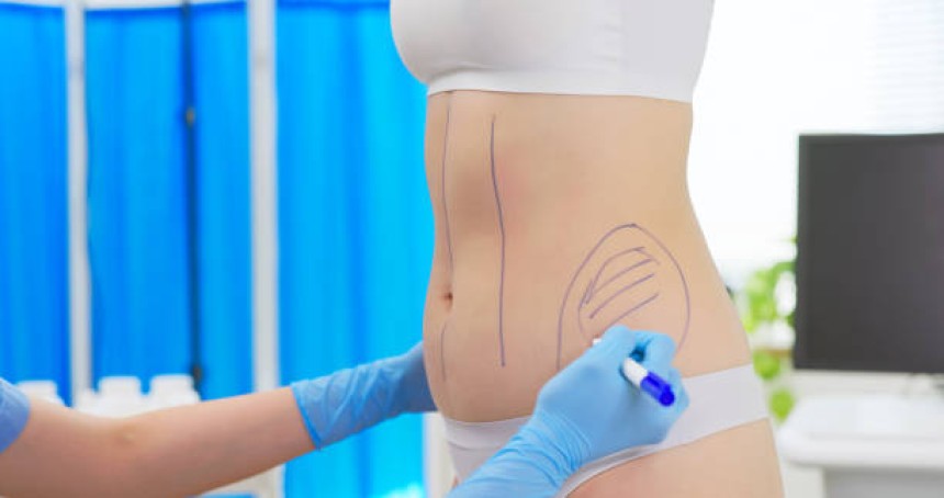 Liposuction in Dubai